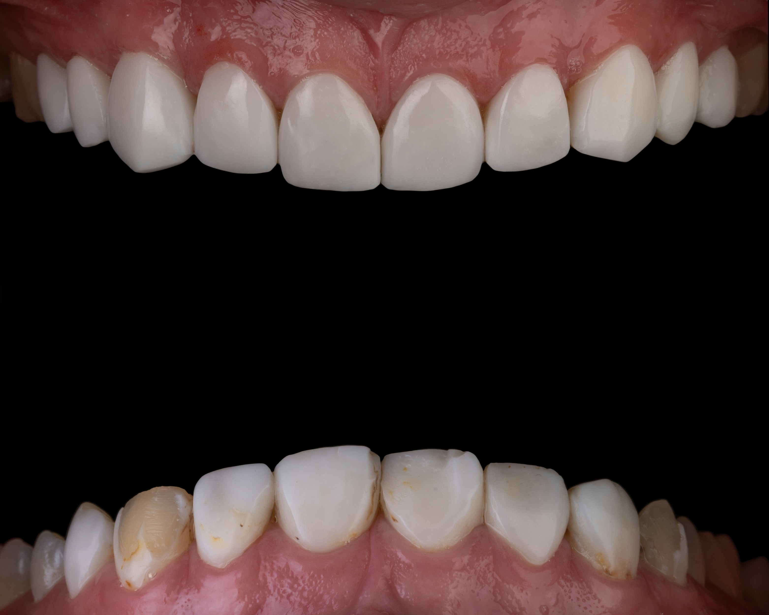 a close up of a tooth with missing teeth — por Kamal Hoseinianzade no Unsplash