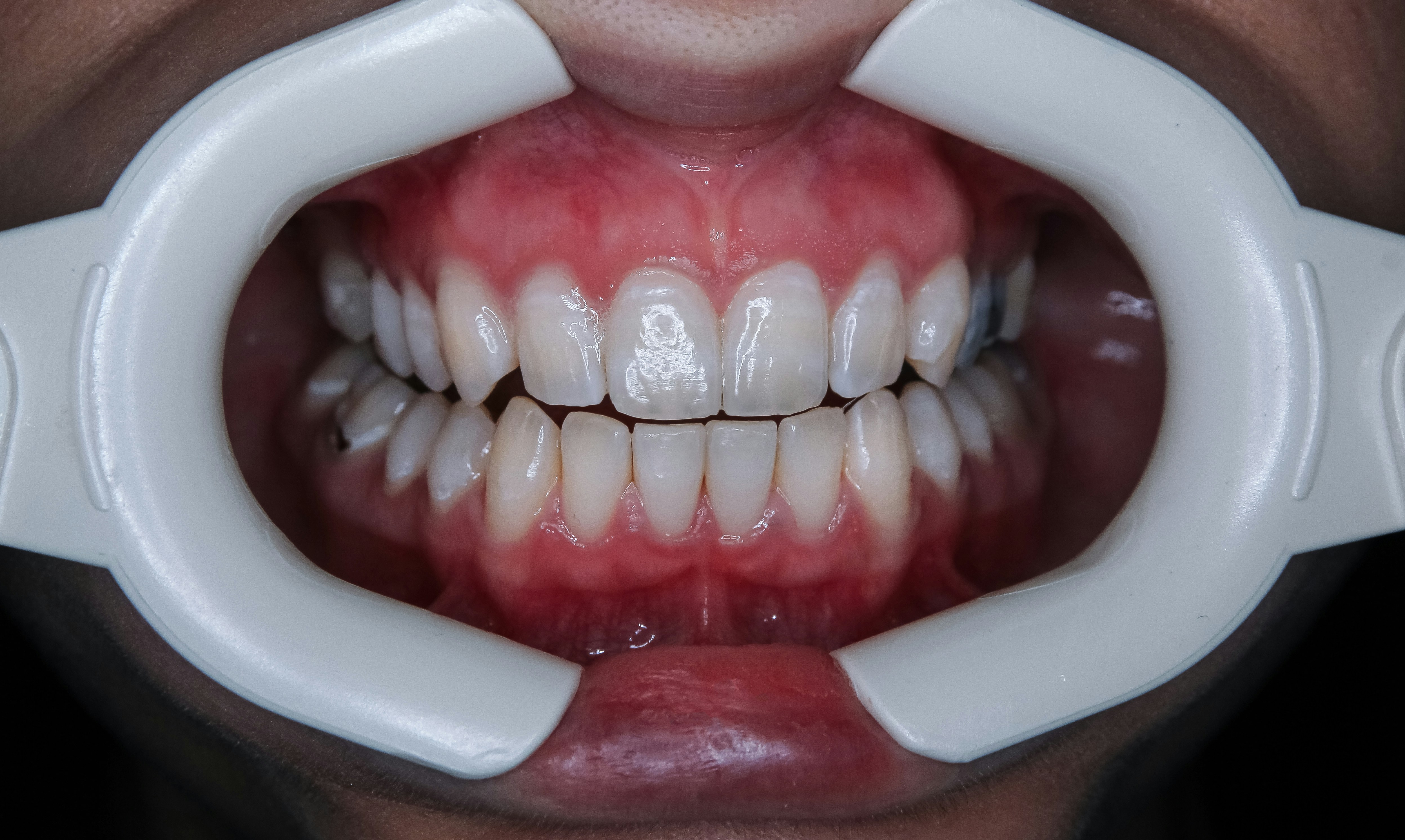 a person's mouth with teeth — por Ozkan Guner no Unsplash